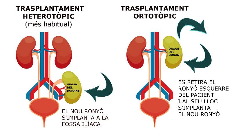 Trasplantet renal ortotópico (Foto. ConSalud)