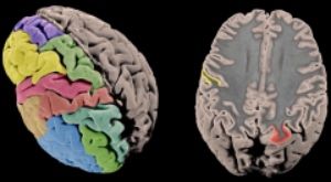 Ejemplo de variaciones en la corteza cerebral (Foto. ConSalud)
