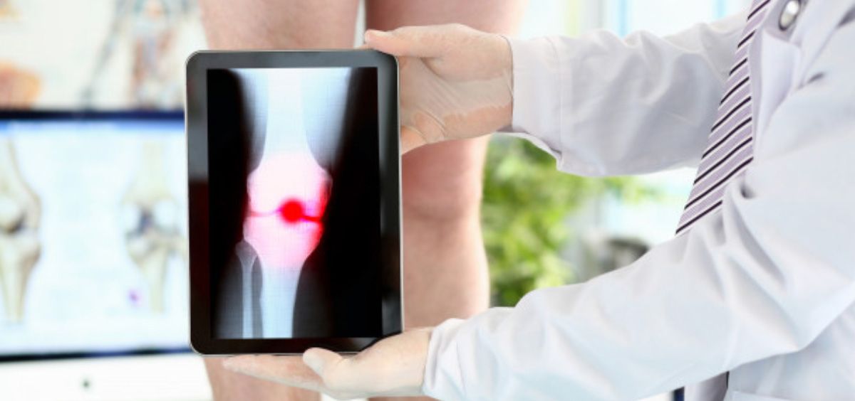 El estudio confirma el impacto negativo de múltiples comorbilidades en el curso de una artrosis de cadera (Foto. Freepik)