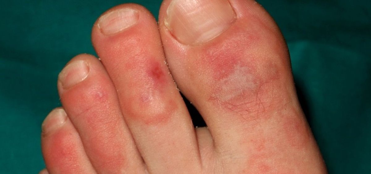 Lesiones dermatológicas en pies (Foto. EP)