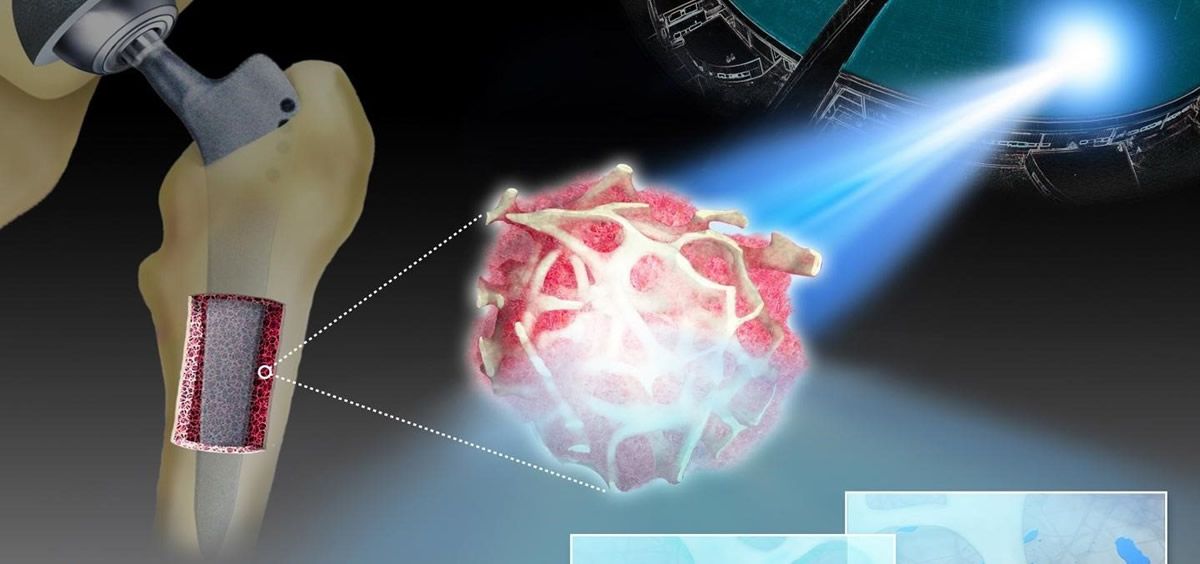 Los metales de los implantes podrían acumularse en el tejido óseo. (Foto. EuropaPress)