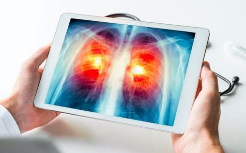 Descubren una posible diana diagnóstica y terapéutica para el cáncer de pulmón