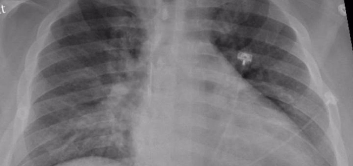 La radiografía de tórax de un paciente positivo de COVID 19 que muestra una neumonía en la parte inferior de los pulmones. (Foto. RADIOLOGICAL SOCIETY OF NORTH AMERICA   Archivo)