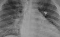 La radiografía de tórax de un paciente positivo de COVID 19 que muestra una neumonía en la parte inferior de los pulmones. (Foto. RADIOLOGICAL SOCIETY OF NORTH AMERICA Archivo)