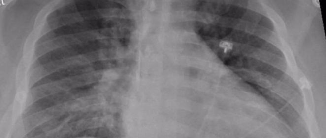 La radiografía de tórax de un paciente positivo de COVID 19 que muestra una neumonía en la parte inferior de los pulmones. (Foto. RADIOLOGICAL SOCIETY OF NORTH AMERICA   Archivo)
