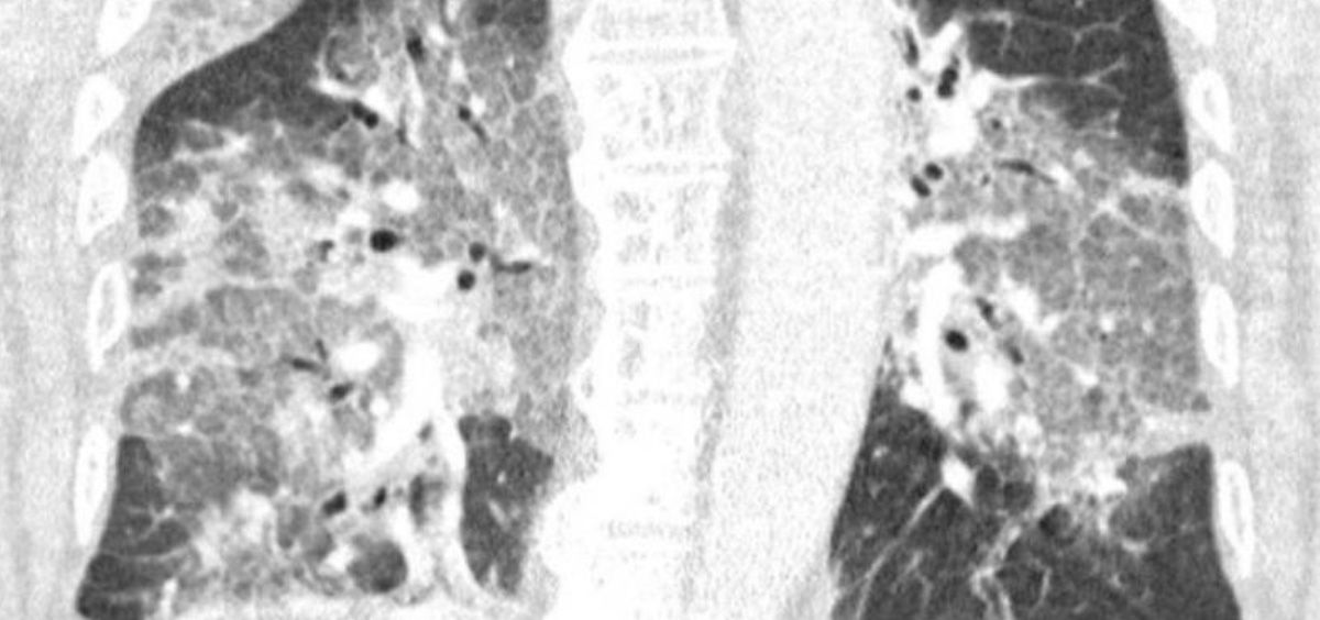 Radiografía de los pulmones del paciente ingresado en la UCI por Covid 19 (Foto. Centro Médico Zuyderland/Servimedia)
