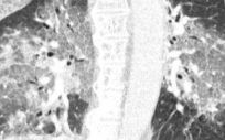Radiografía de los pulmones del paciente ingresado en la UCI por Covid 19 (Foto. Centro Médico Zuyderland/Servimedia)