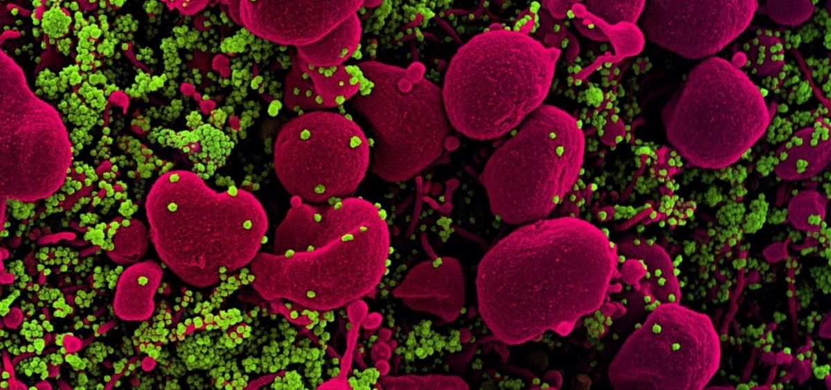 Micrografía electrónica de barrido coloreada de una célula apoptótica (rosa) muy infectada con partículas del virus SARS COV 2 (verde), aislada de una muestra de un paciente. (Foto. EP)