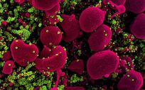 Micrografía electrónica de barrido coloreada de una célula apoptótica (rosa) muy infectada con partículas del virus SARS COV 2 (verde), aislada de una muestra de un paciente. (Foto. EP)