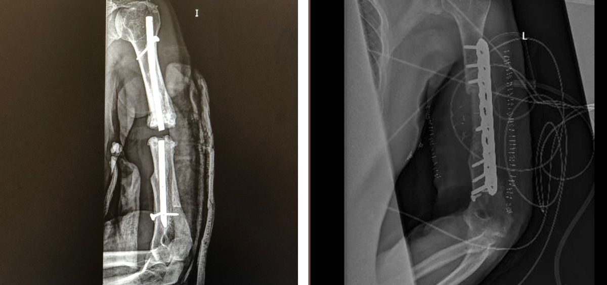 Imágenes de antes y después de la intervención (Foto. Hospital de Villalba)