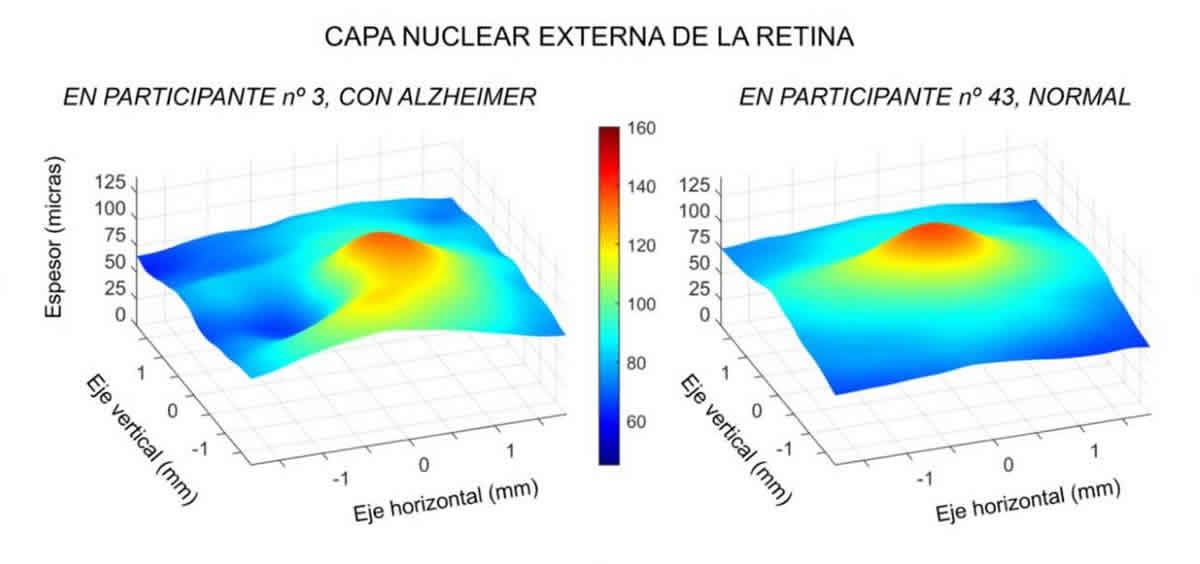 Comparación de dos capas de la retina de pacientes con y sin Alzheimer. (Foto: Jáñez García et. Al.)