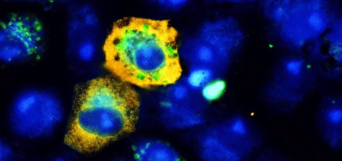 Cuando el SARS-CoV-2 (amarillo) infecta las células de riñón de mono, reduce el mecanismo de reciclaje celular, lo que significa que hay menos señales de autofagia (verde) que en las células no infectadas (Foto: University Hospital Bonn)