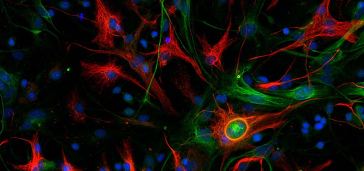 Glioblastoma mesenquimal de ratón con las células madre marcadas en color verde y las células diferenciadas en rojo (Foto CNIO)