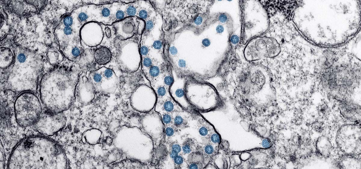Partículas del virus SARS CoV 2, coloreadas en azul, en una imagen de microscopio de electrones. (Foto. CDC)