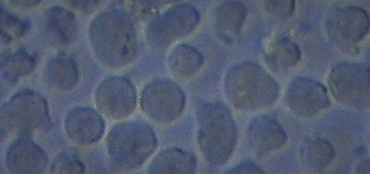 Células de una leucemia aguda de tipo B, enfermedad contra la cual ha demostrado eficacia el tratamiento con células CAR-T (Foto: Instituto de Investigación Leucemia Josep Carreras)