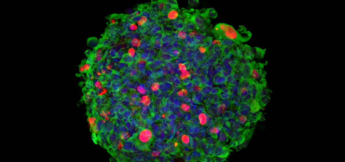 Imagen 3D de inmuno-microscopía confocal de una neuroesfera originada por células madre aisladas de un paciente de glioblastoma (GSC), e infectadas por el parvovirus Minute Virus of Mice (MVM) (Foto: CBMSO, UAM, CSIC)