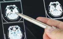 Radiografía de un cerebro sin isquemia o ictus (Foto. Freepik)