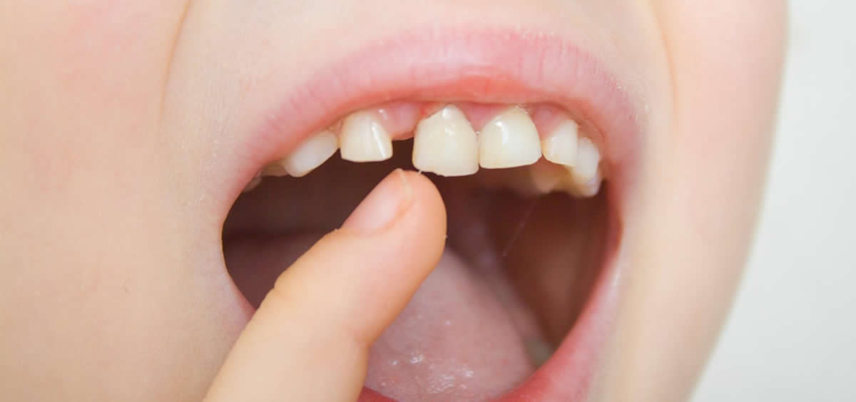 Dientes de un niño (Foto: Compromiso y Seguridad Dental)