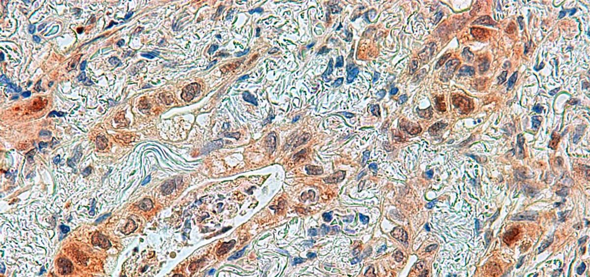 Imagen al microscopio de un adenocarcinoma de pulmón con la proteína ERK5 marcada en marrón en las células tumorales (Foto: Hospital Clínico Universitario de Salamanca/CSIC)