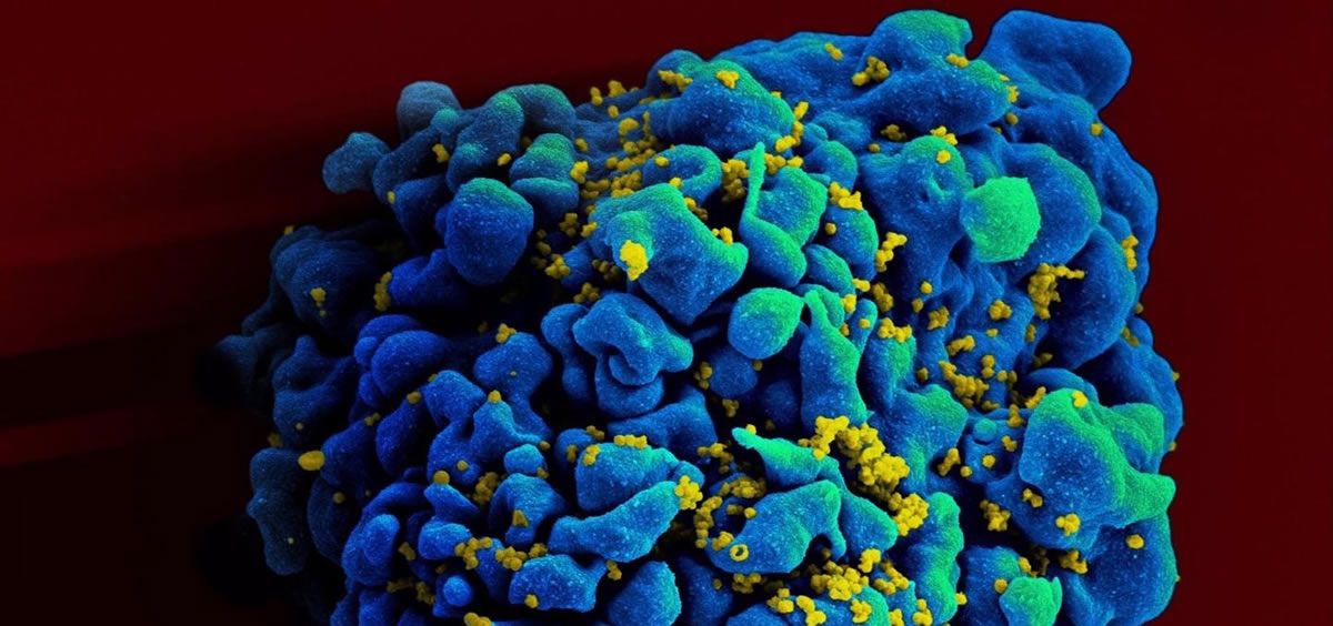 Escaneo electromicrográfico de una célula T infectada con VIH (Foto: NIAID)