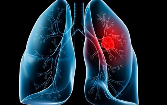 Reducen alteraciones en la memoria en metástasis por cáncer de pulmón
