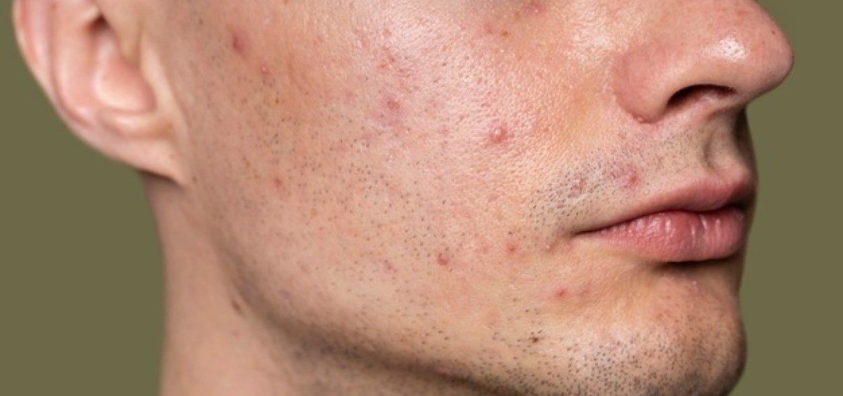 Hombre con acné (Foto. Freepik)