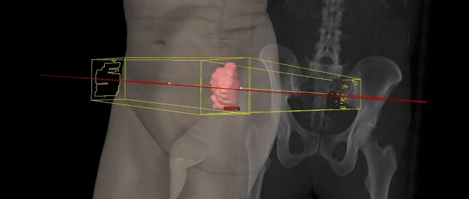 Planificador en 3D del tratamiento en rojo la zona radiada
