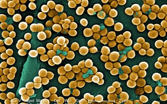 La infección por Staphylococcus Aureus es la más frecuente en los hospitales españoles