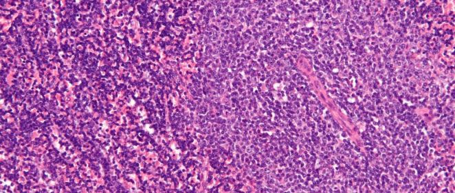 Micrografía de un nodo linfático afectado por leucemia linfocítica crónica. (Foto. Nephron. CSIC)