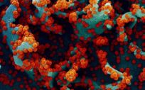 Micrografía electrónica de barrido coloreada de una célula infectada con SARS CoV 2 (Foto. EP)