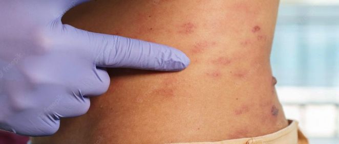 Lesiones causadas por el herpes zóster (Foto. Freepik)