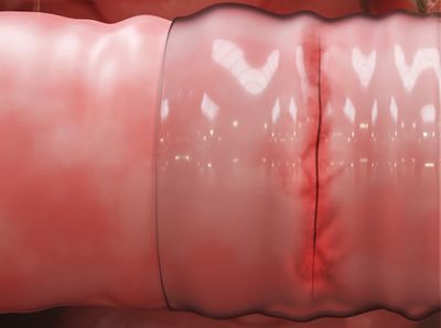 Parte de un intestino animal con la cinta adhesiva (Foto. MIT)