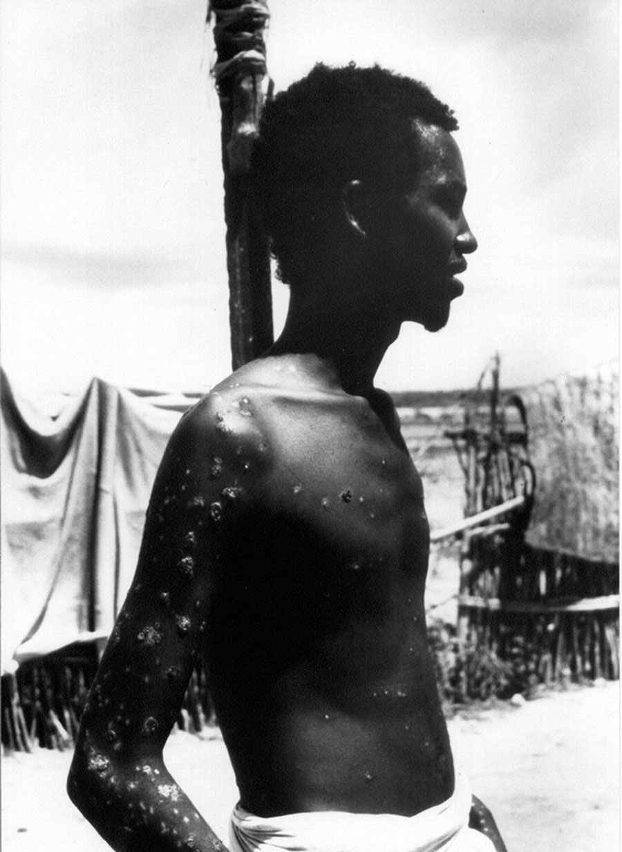 Ali Maow Maalin, de 23 años, de la ciudad de Merka, Somalia, el último caso registrado de la enfermedad de la viruela, en 1977, fotografía de la  OMS y John F. Wickett