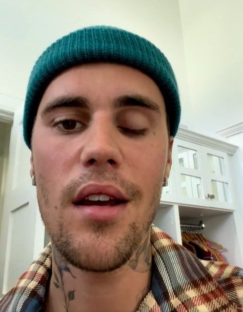 Justin Bieber con parálisis facial