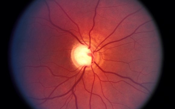 La toma prolongada de algunos fármacos como los corticoides puede favorecer el glaucoma