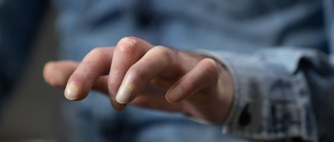 Las manos de Alfonso Sánchez, paciente de esclerodermia (Foto. Cedida por el paciente)