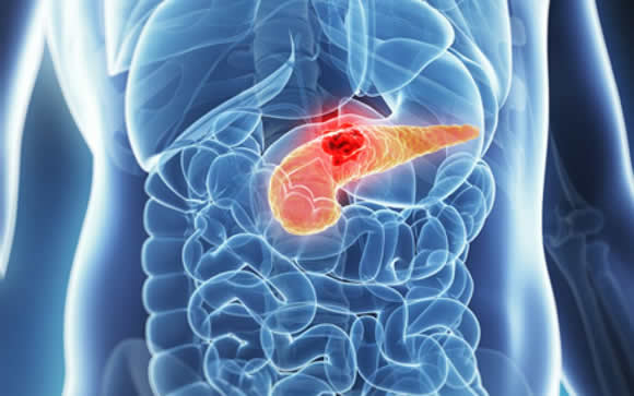 En 5 años, el de páncreas será la segunda causa de muerte por cáncer