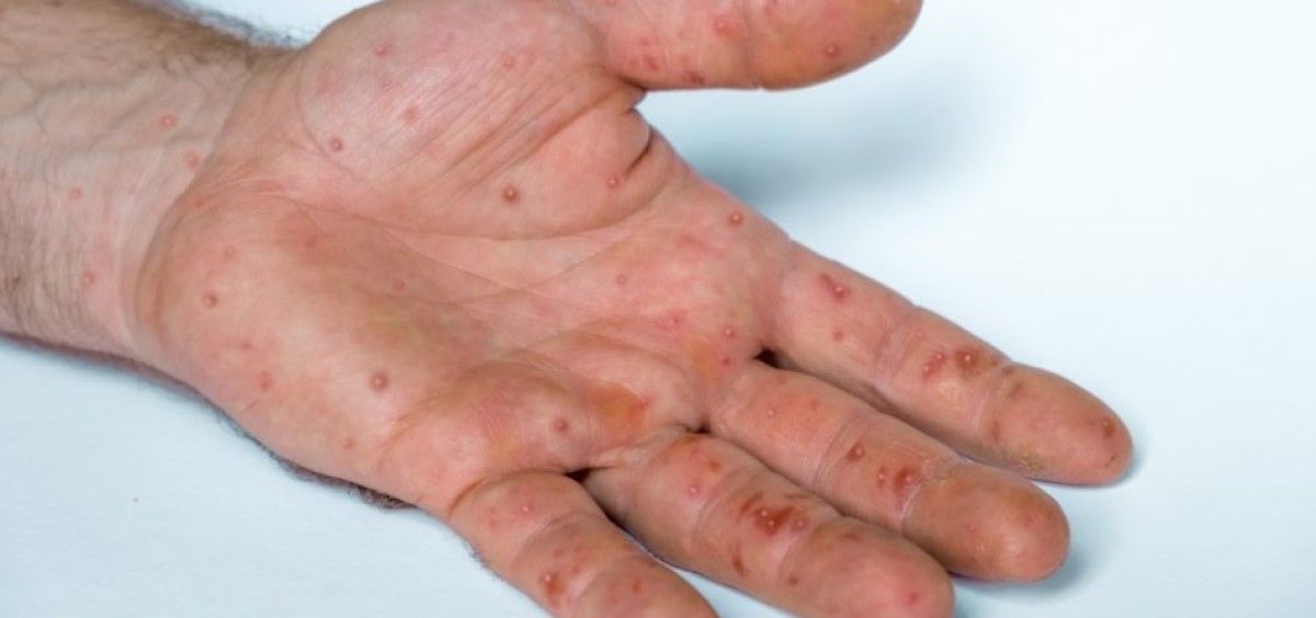 Lesiones en la mano provocadas por la viruela del mono. (foto. cecova)