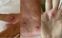 Lesiones cutáneas de viruela del mono de los primeros 15 días (Foto: Journal of Infeccion)
