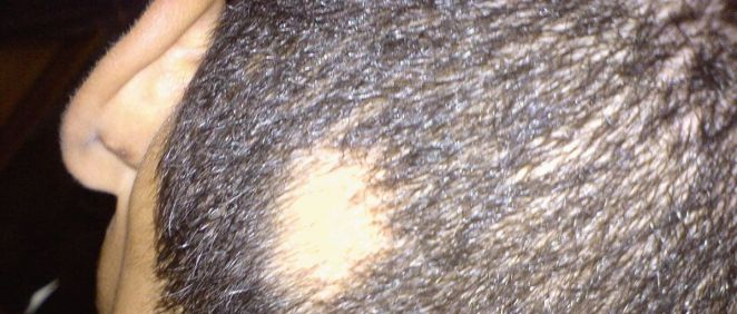 Alopecia areata (Foto: Compromís)