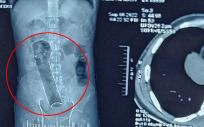 Radiografía del paciente en la que se aprecia el bote de desodorante de casi 20 centímetros que tuvo en el colon durante 20 días. (Foto. Jam Press)