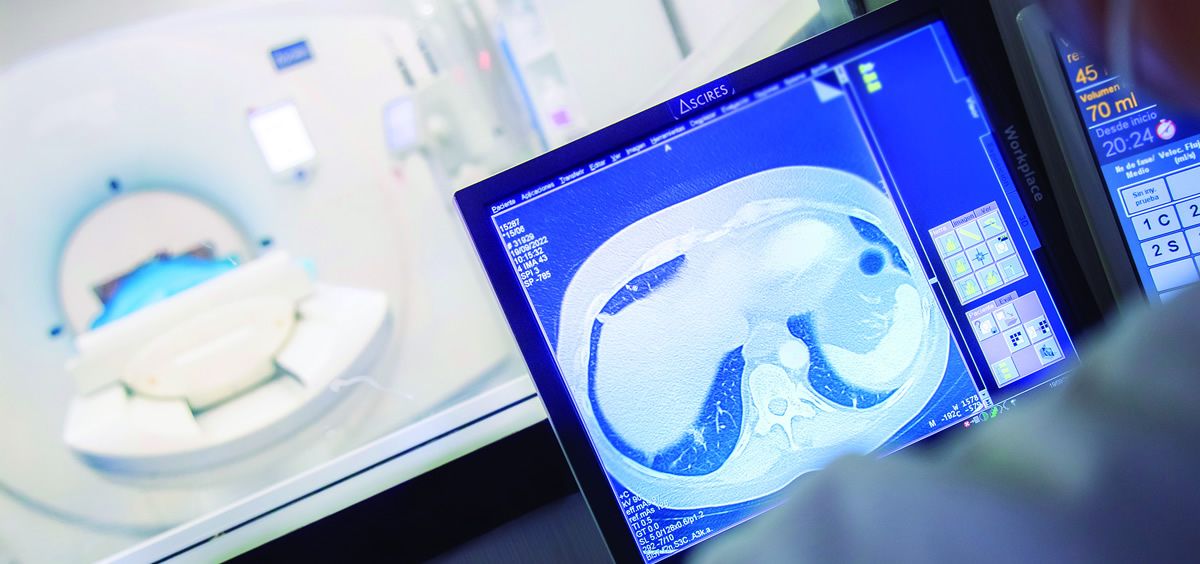 La tomografía computarizada (TAC) de pulmón permite detectar de manera precoz un posible cáncer de pulmón (Foto. Ascires)