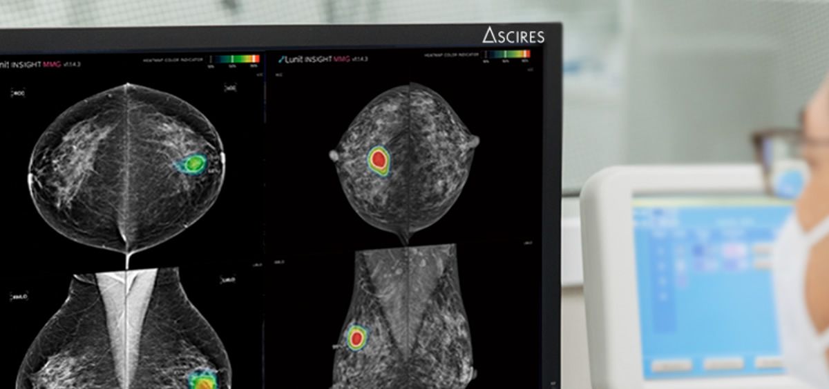 Mamografía realiza con el software de inteligencia artificial LUNIT (Foto. Ascires Grupo Biomédico)