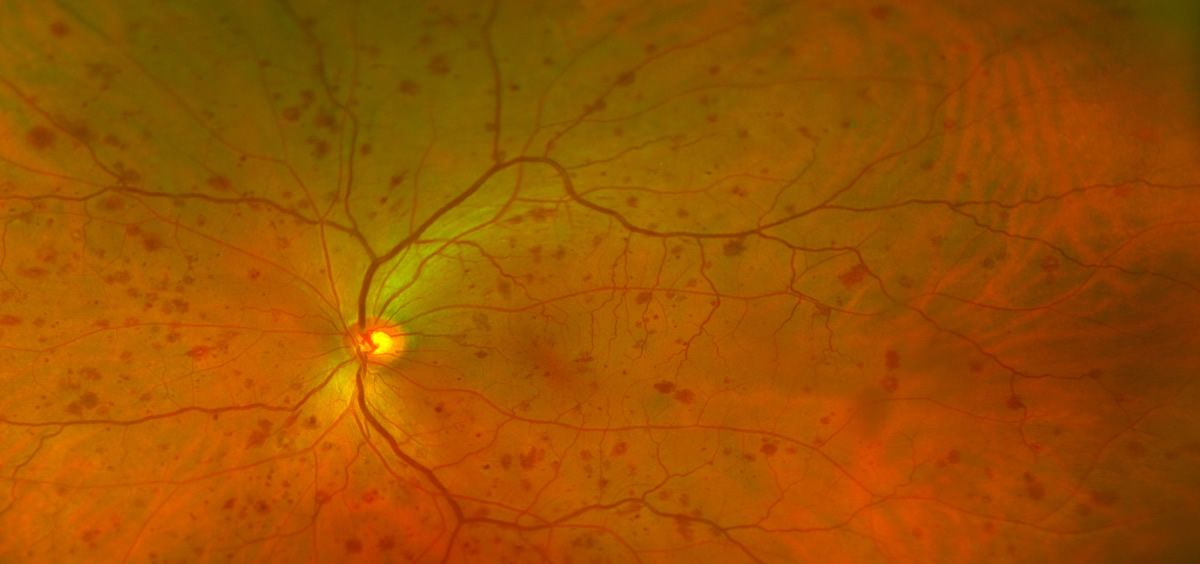 Imagen de la cámara de fondo de ojo oftalmoscopio de la retina mostrando  aguda la retinopatía diabética proliferativa Fotografía de stock  Alamy