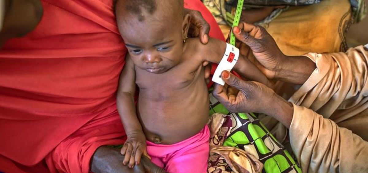 Profesional de la salud midiendo a un niño en tratamiento por densutrición en Nigeria (Foto. UNICEF/UN0260697/Esiebo)