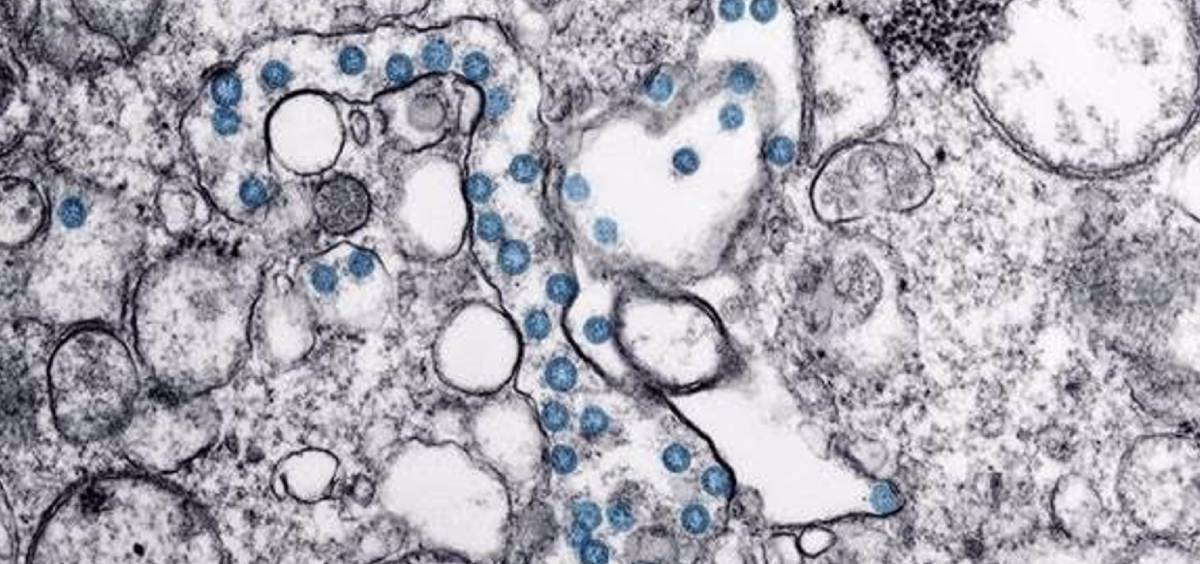 Partículas del virus SARS-CoV-2, coloreadas en azul, en una imagen de microscopio de electrones. (Foto: CDC)