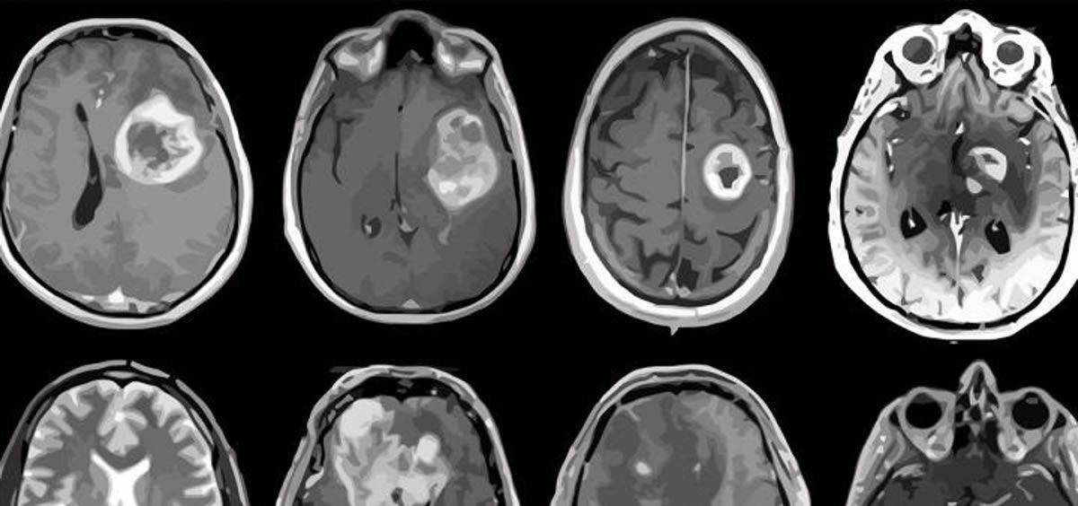 Glioblastoma, tumor cerebral agresivo mapeado en detalle genético y molecular (Foto: Albert H. Kim/EuropaPress)
