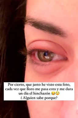 Dulceida comparte su ojo inflamado en Instagram (Foto. @dulceida)