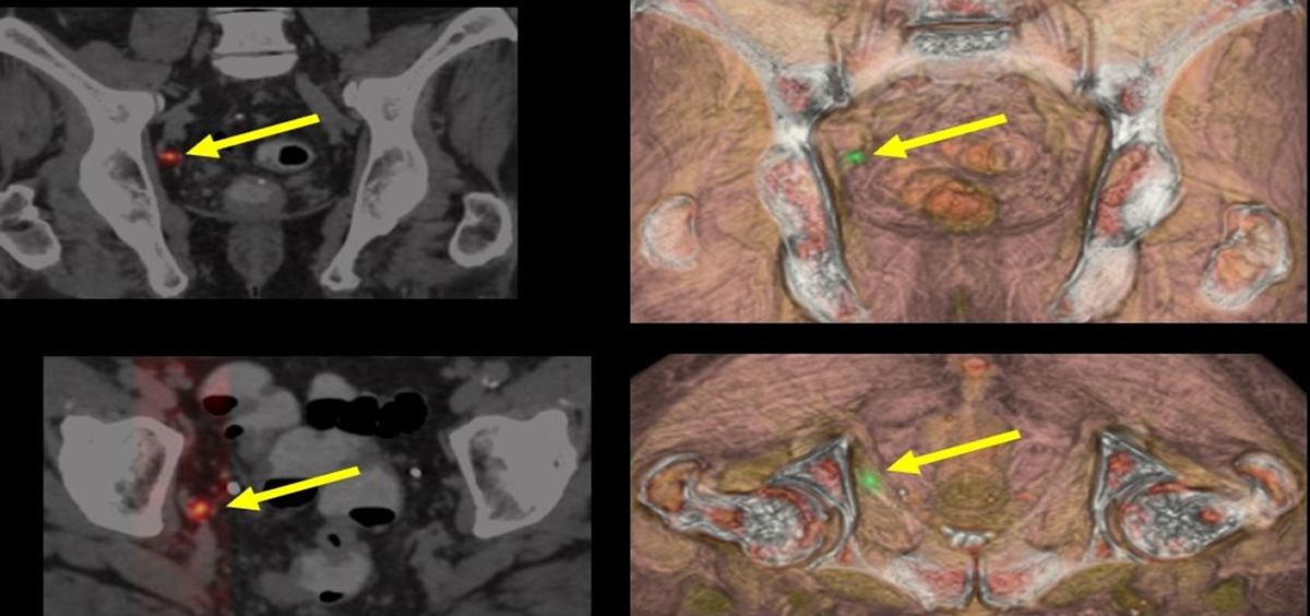  PET-CT PSMA: recidiva ganglionar del cáncer de próstata (Foto: Hospital Universitario La Luz)
