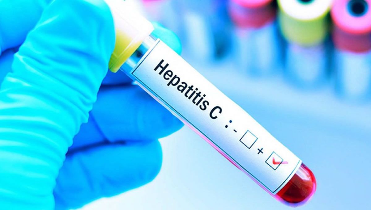 Análisis de sangre positivo en hepatitis C (Foto. Freepik)